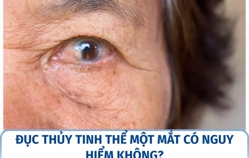 Đục thủy tinh thể một mắt có nguy hiểm không?