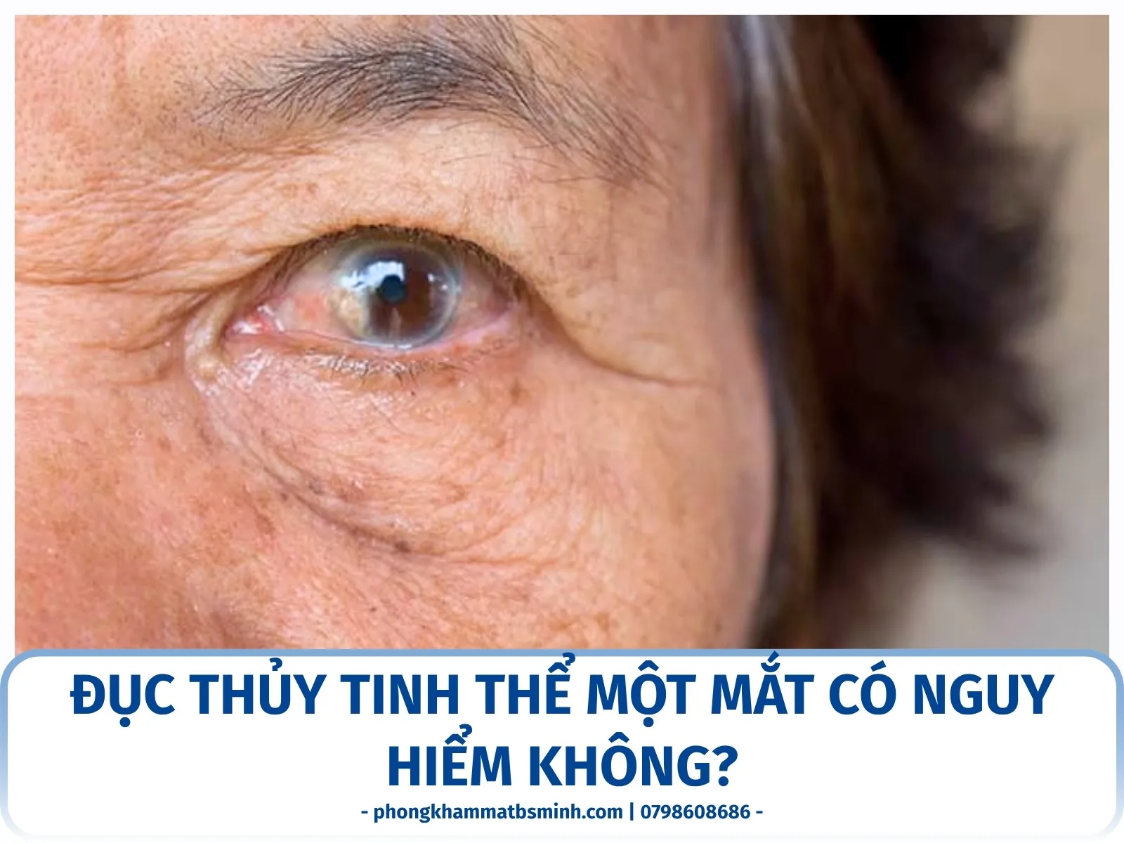 Đục thủy tinh thể một mắt có nguy hiểm không?