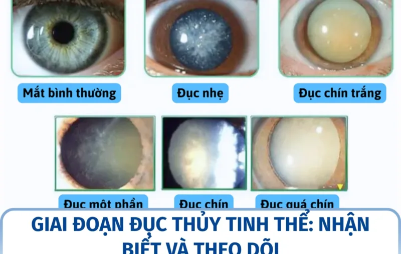 Giai đoạn đục thủy tinh thể: nhận biết và theo dõi
