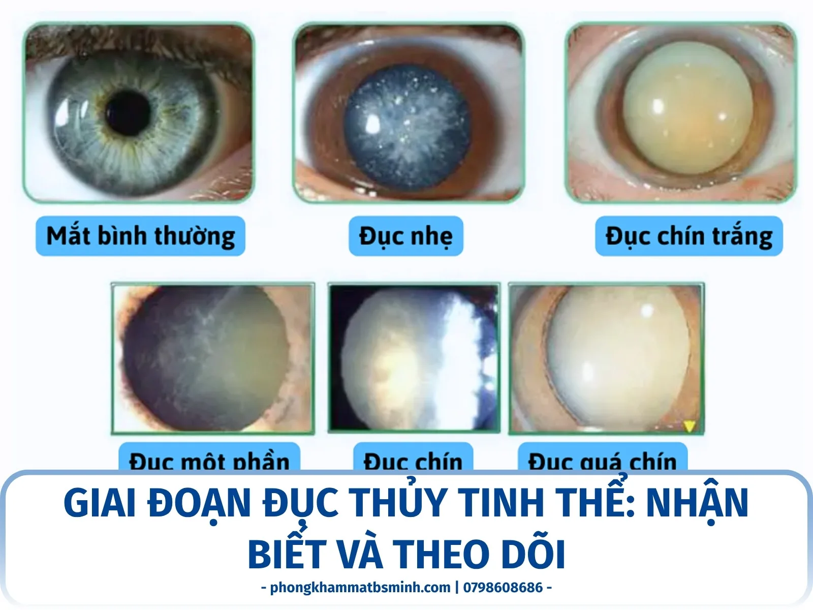 Giai đoạn đục thủy tinh thể: nhận biết và theo dõi
