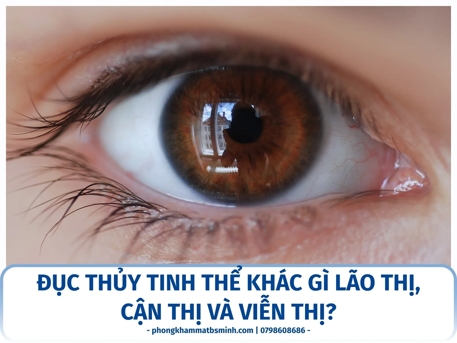 Đục thủy tinh thể khác gì lão thị, cận thị và viễn thị?