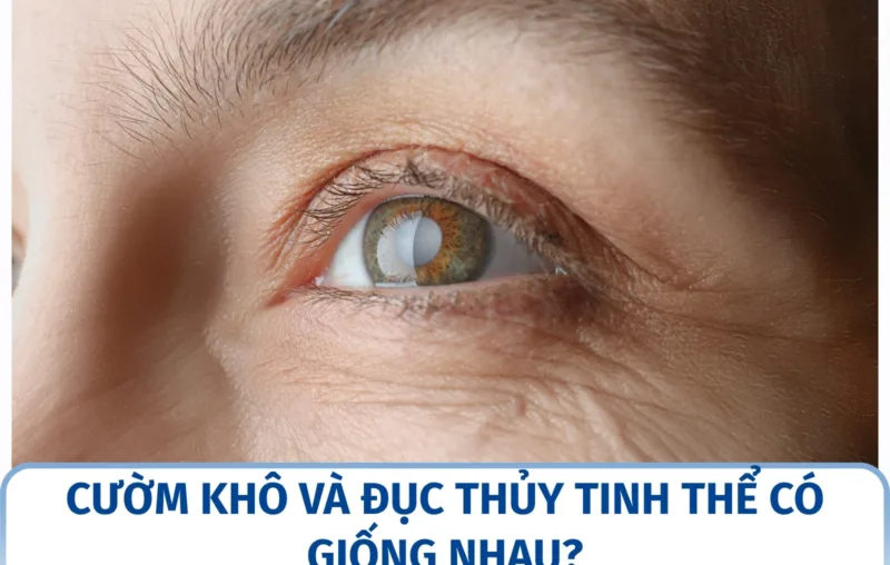Đục thủy tinh thể là gì? Dấu hiệu nhận biết sớm