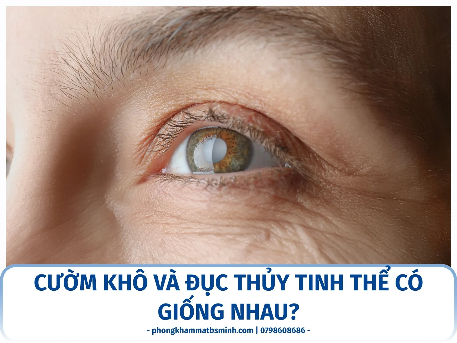 Đục thủy tinh thể là gì? Dấu hiệu nhận biết sớm