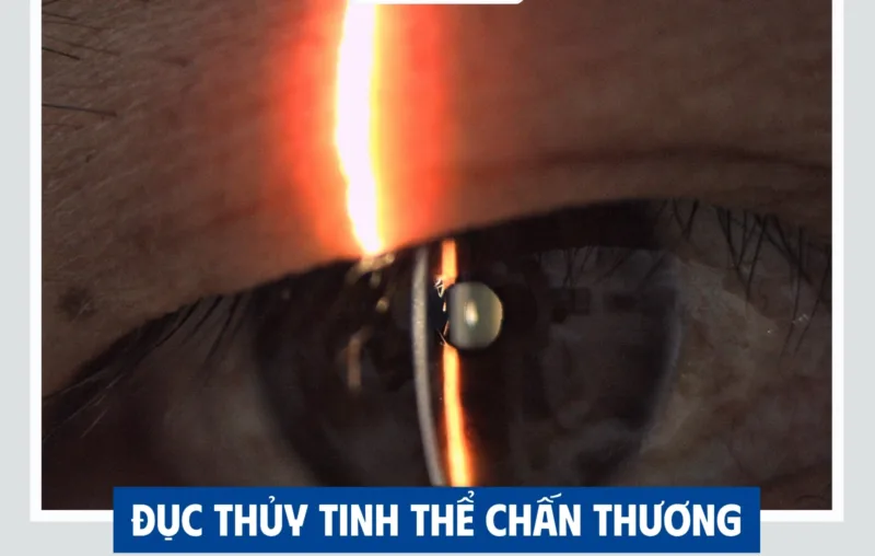 Đục thủy tinh thể có điều trị bằng thuốc được không?