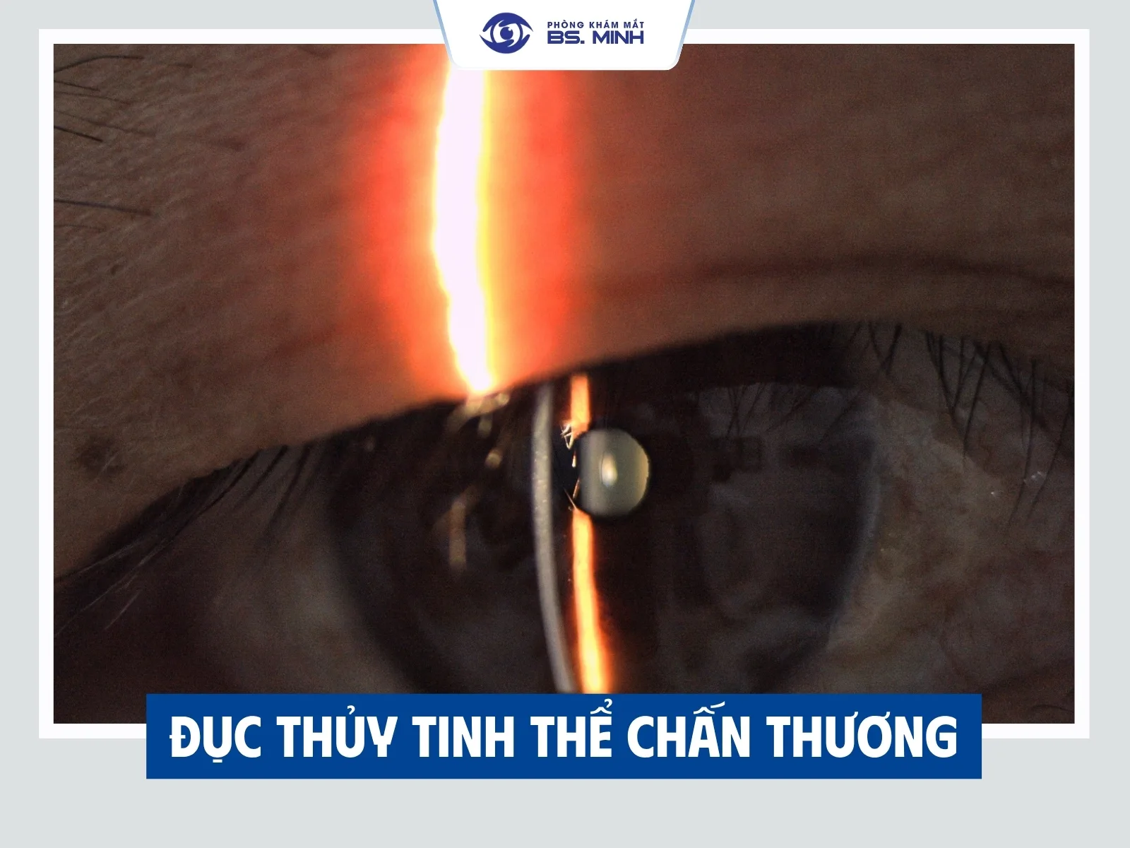 Đục thủy tinh thể có điều trị bằng thuốc được không?