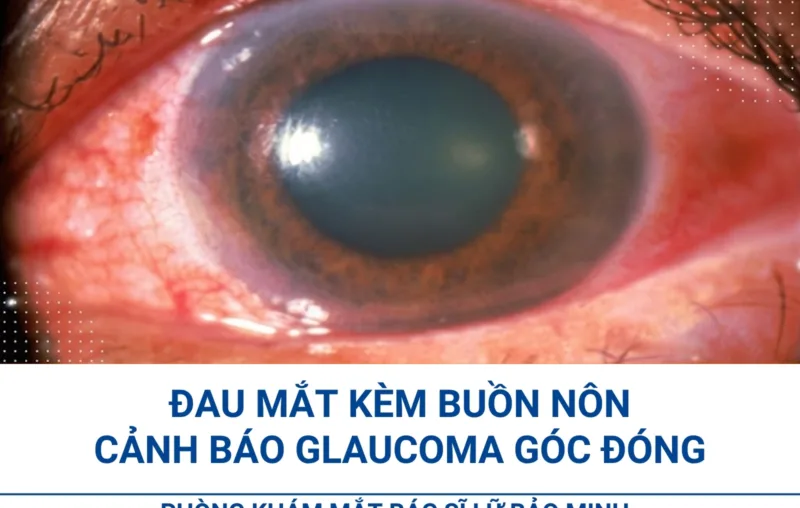 Đau mắt kèm buồn nôn cảnh báo glaucoma góc đóng