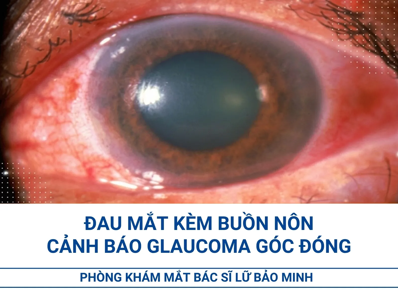 Đau mắt kèm buồn nôn cảnh báo glaucoma góc đóng