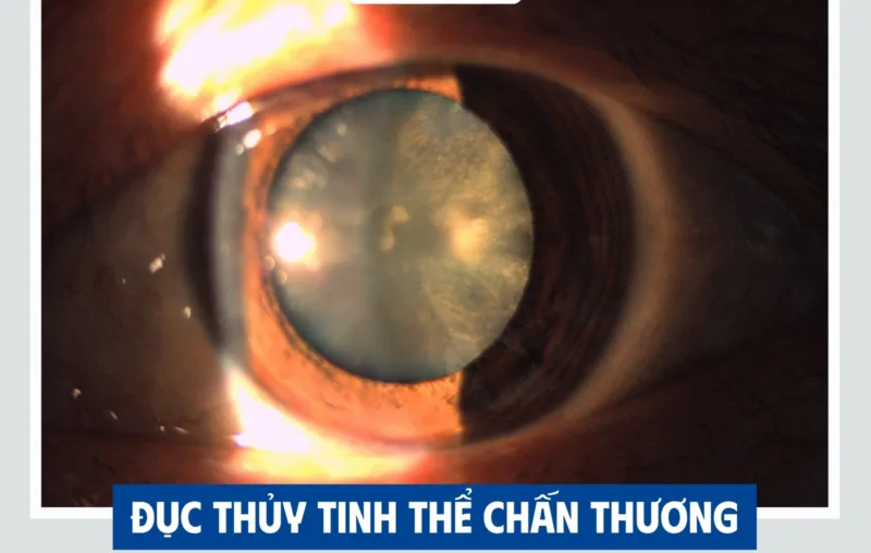 Khi nào cần mổ đục thủy tinh thể? Dấu hiệu cần biết