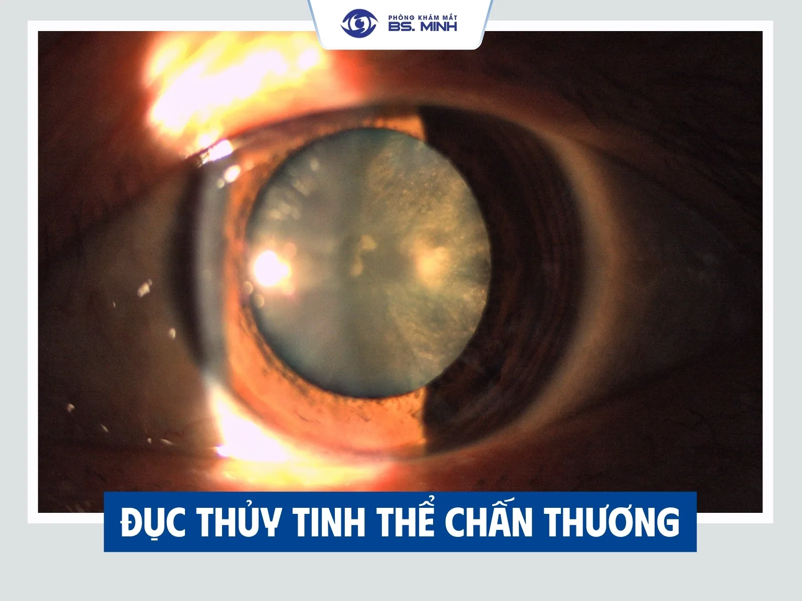 Khi nào cần mổ đục thủy tinh thể? Dấu hiệu cần biết