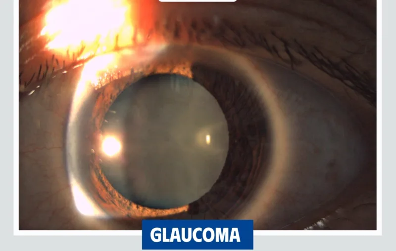 glaucoma