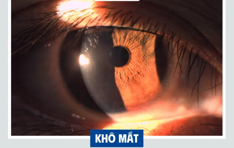 khô mắt