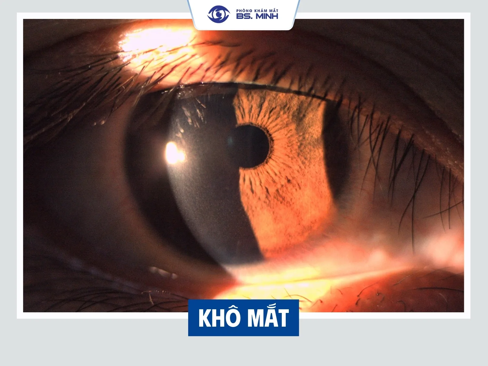 khô mắt