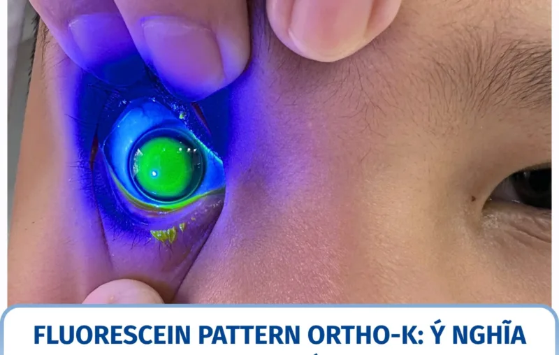 Fluorescein pattern Ortho-K: ý nghĩa khi fit kính