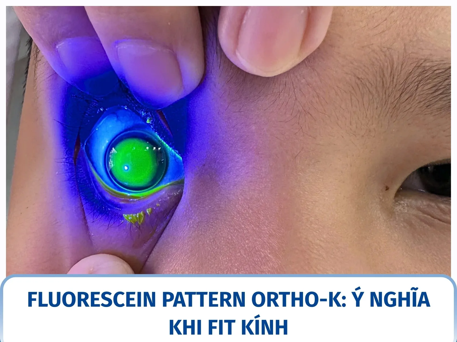 Fluorescein pattern Ortho-K: ý nghĩa khi fit kính