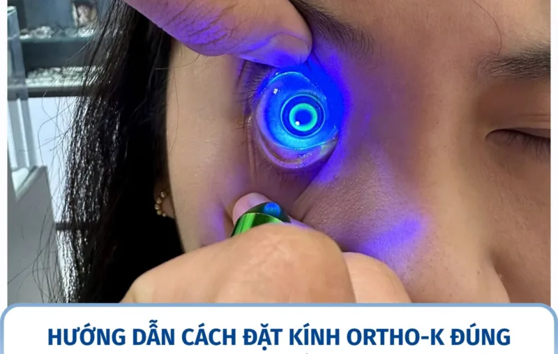Hướng dẫn cách đặt kính Ortho-K đúng vị trí