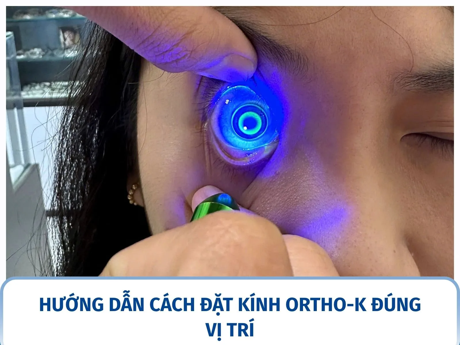 Hướng dẫn cách đặt kính Ortho-K đúng vị trí