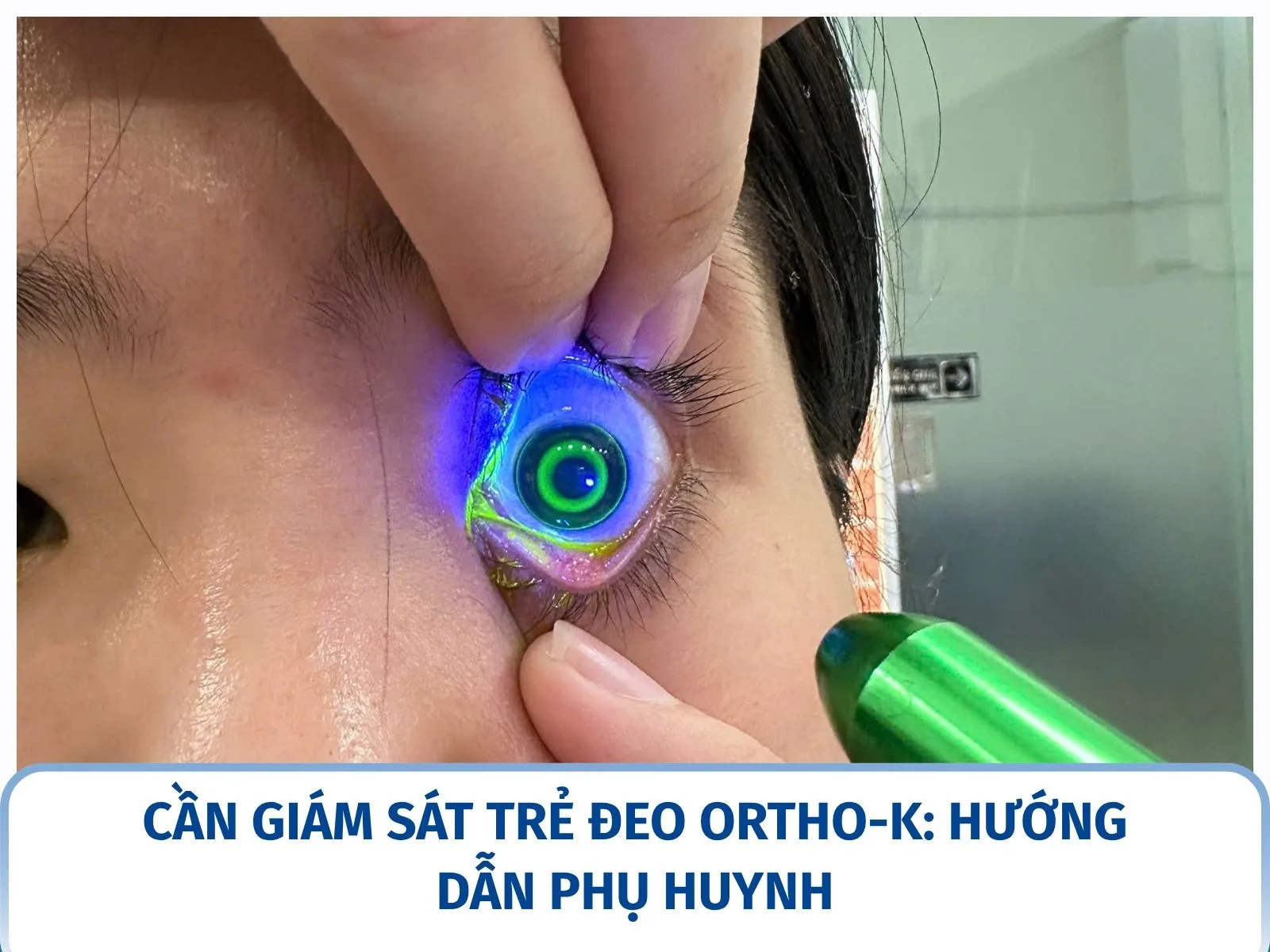 Cần giám sát trẻ đeo Ortho-K: hướng dẫn phụ huynh