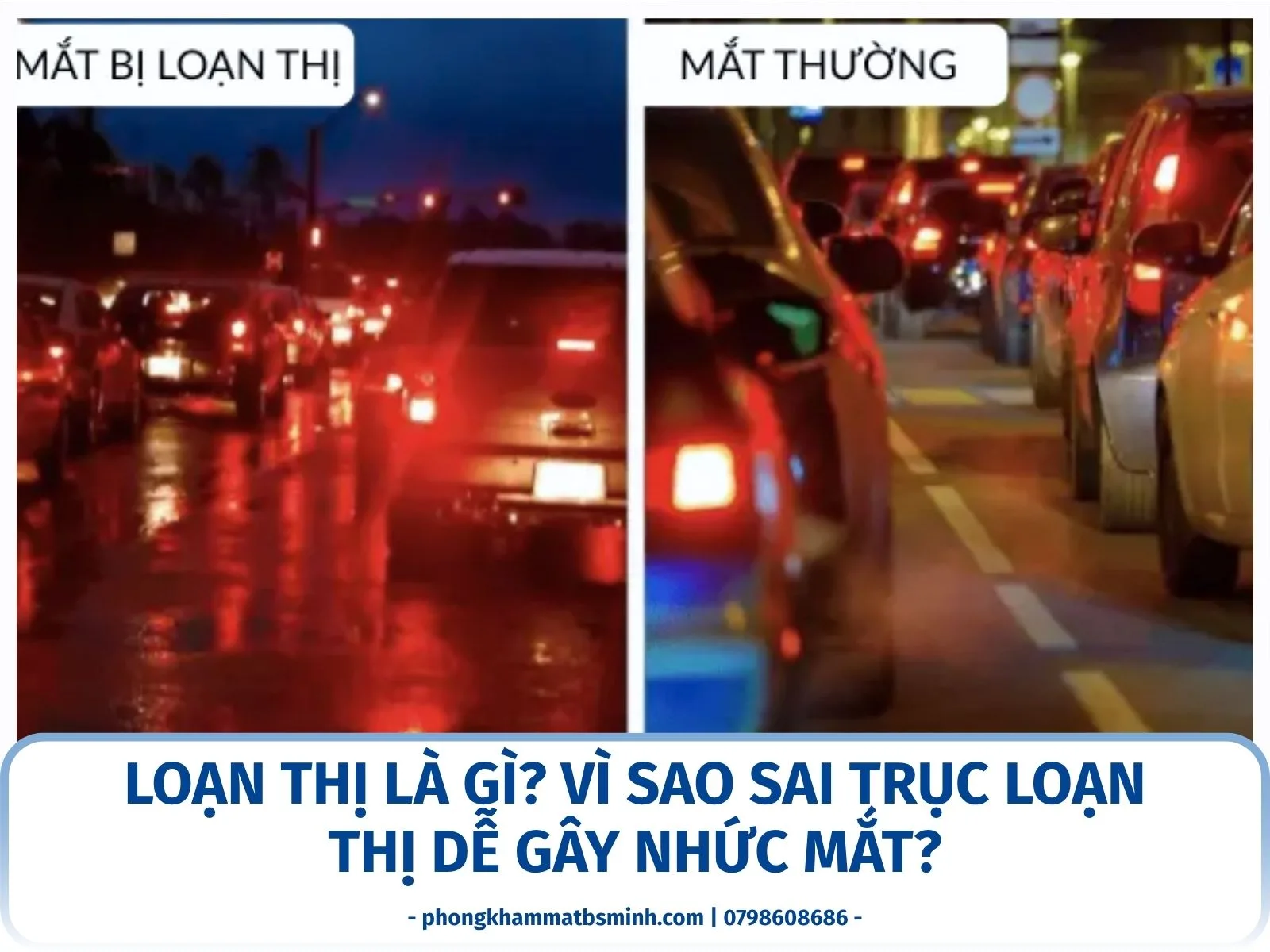 Loạn thị là gì? Vì sao sai trục loạn thị dễ gây nhức mắt?
