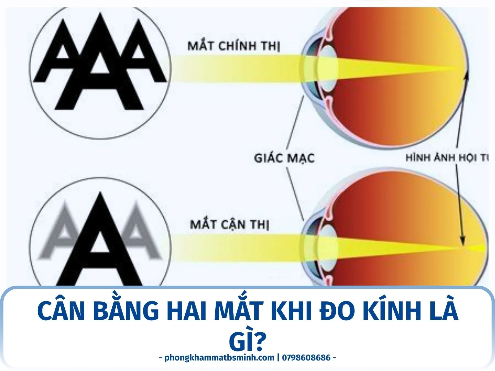 Cân bằng hai mắt khi đo kính là gì?