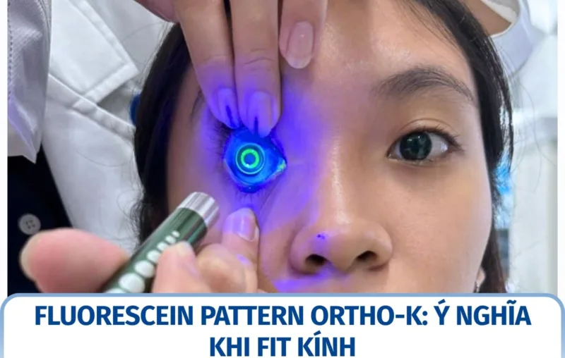 Fluorescein pattern khi fit Ortho-K có ý nghĩa gì?