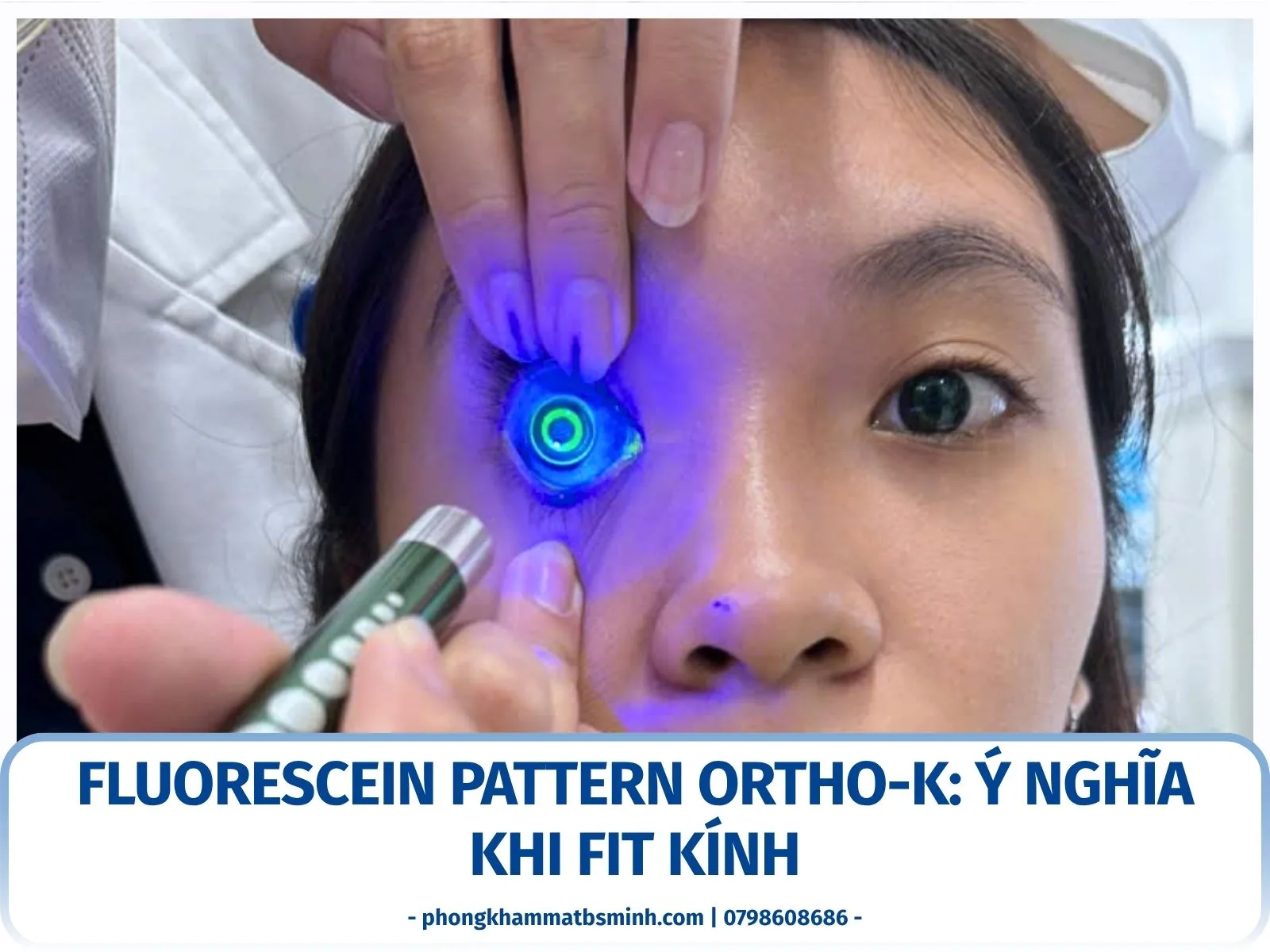 Fluorescein pattern khi fit Ortho-K có ý nghĩa gì?