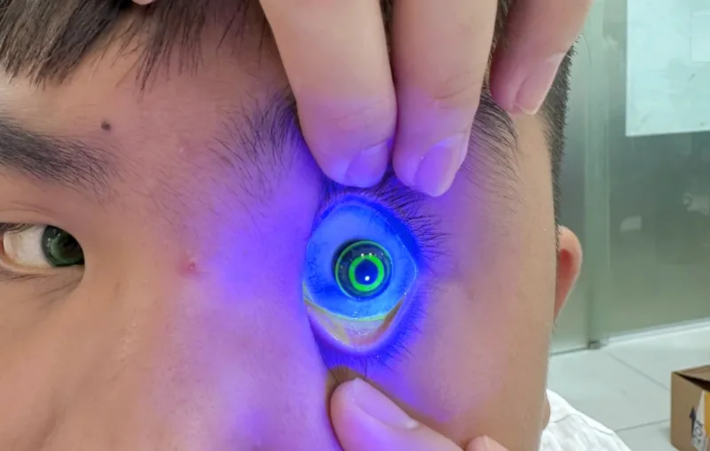 Đeo Ortho-K bị cộm mắt