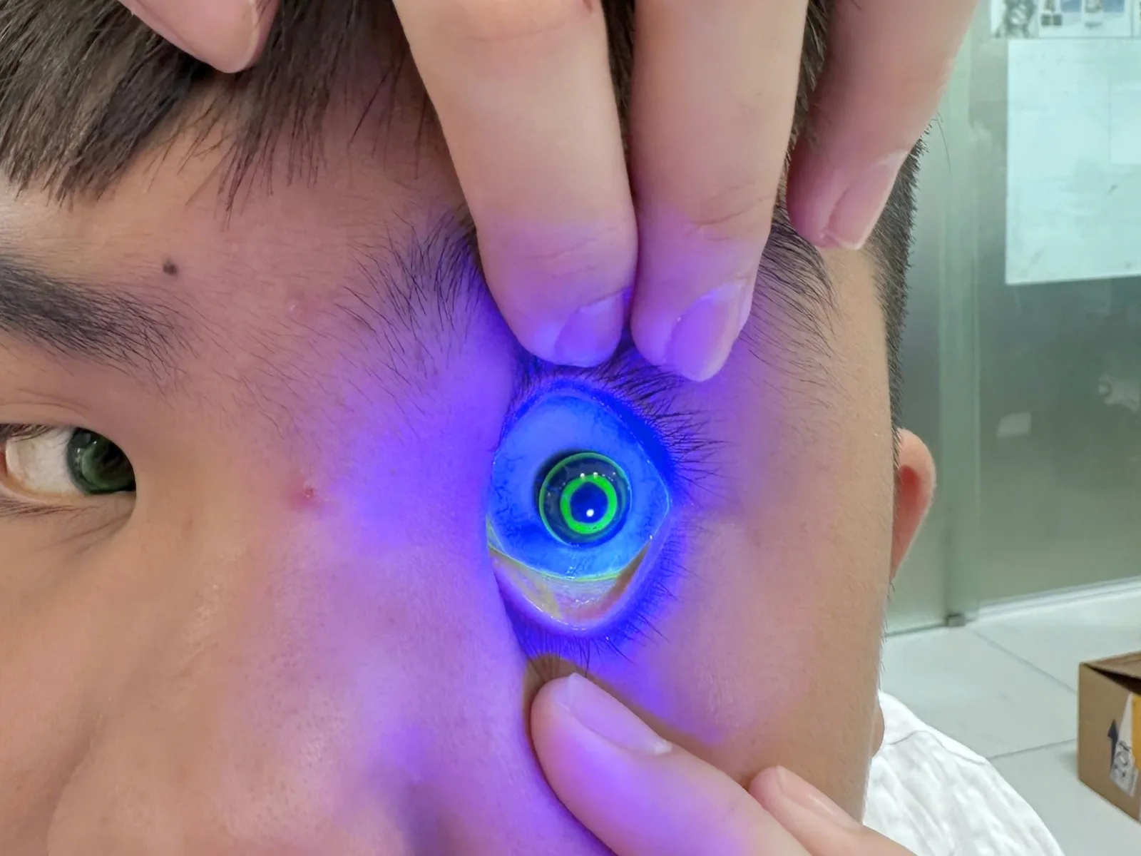 Đeo Ortho-K bị cộm mắt