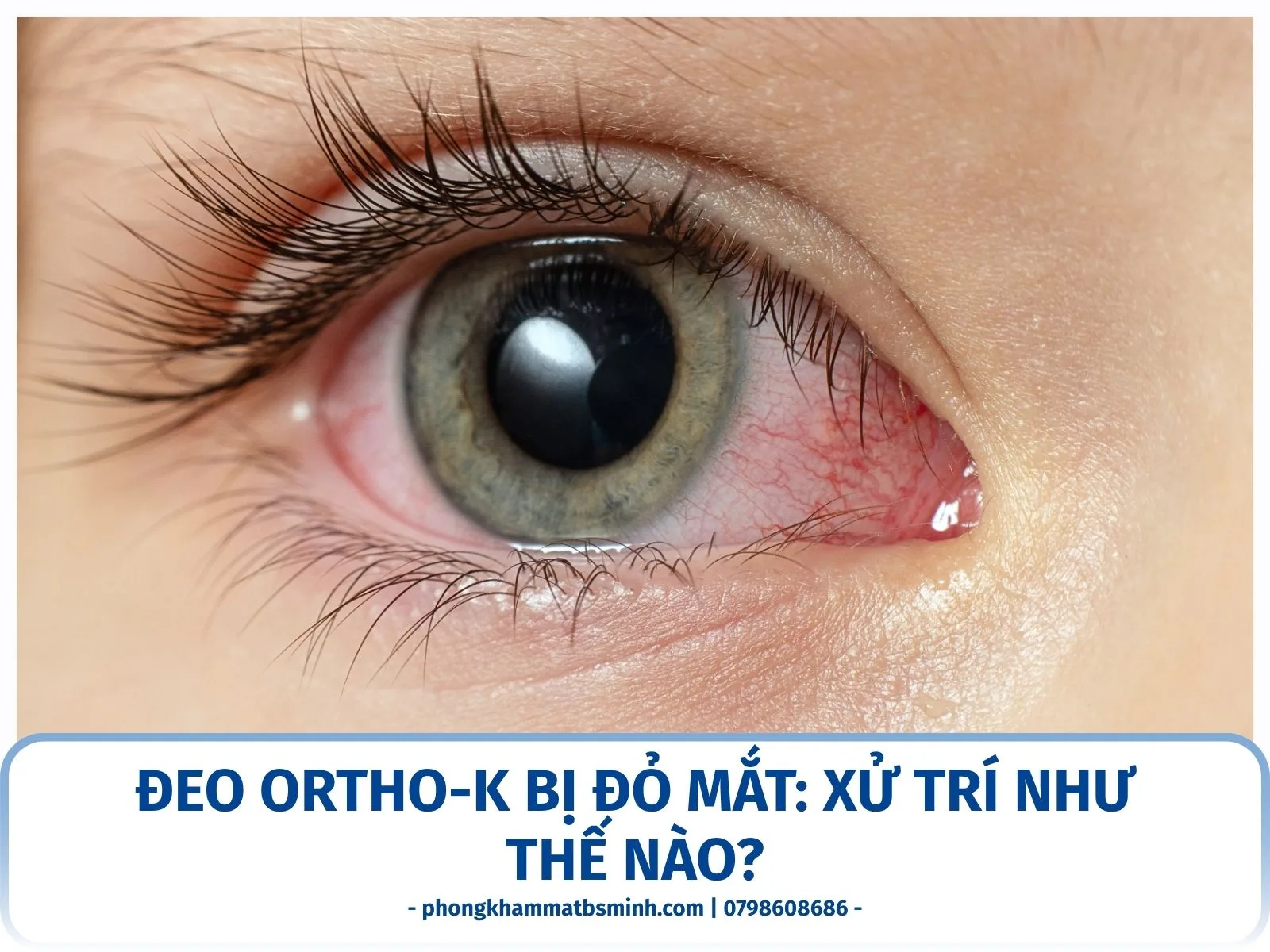 Đeo Ortho-K bị đỏ mắt: xử trí như thế nào?