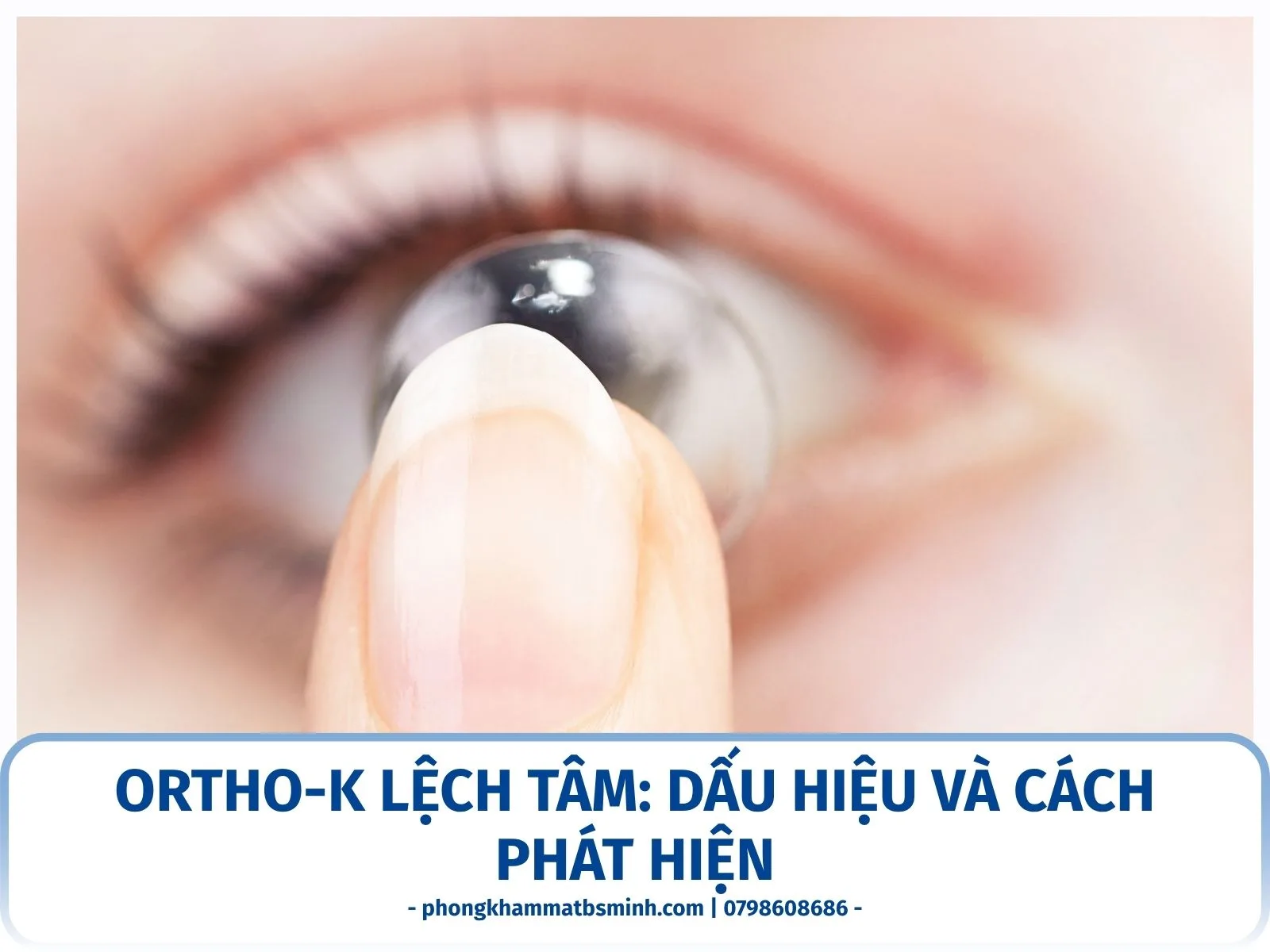Ortho-K lệch tâm: dấu hiệu và cách phát hiện
