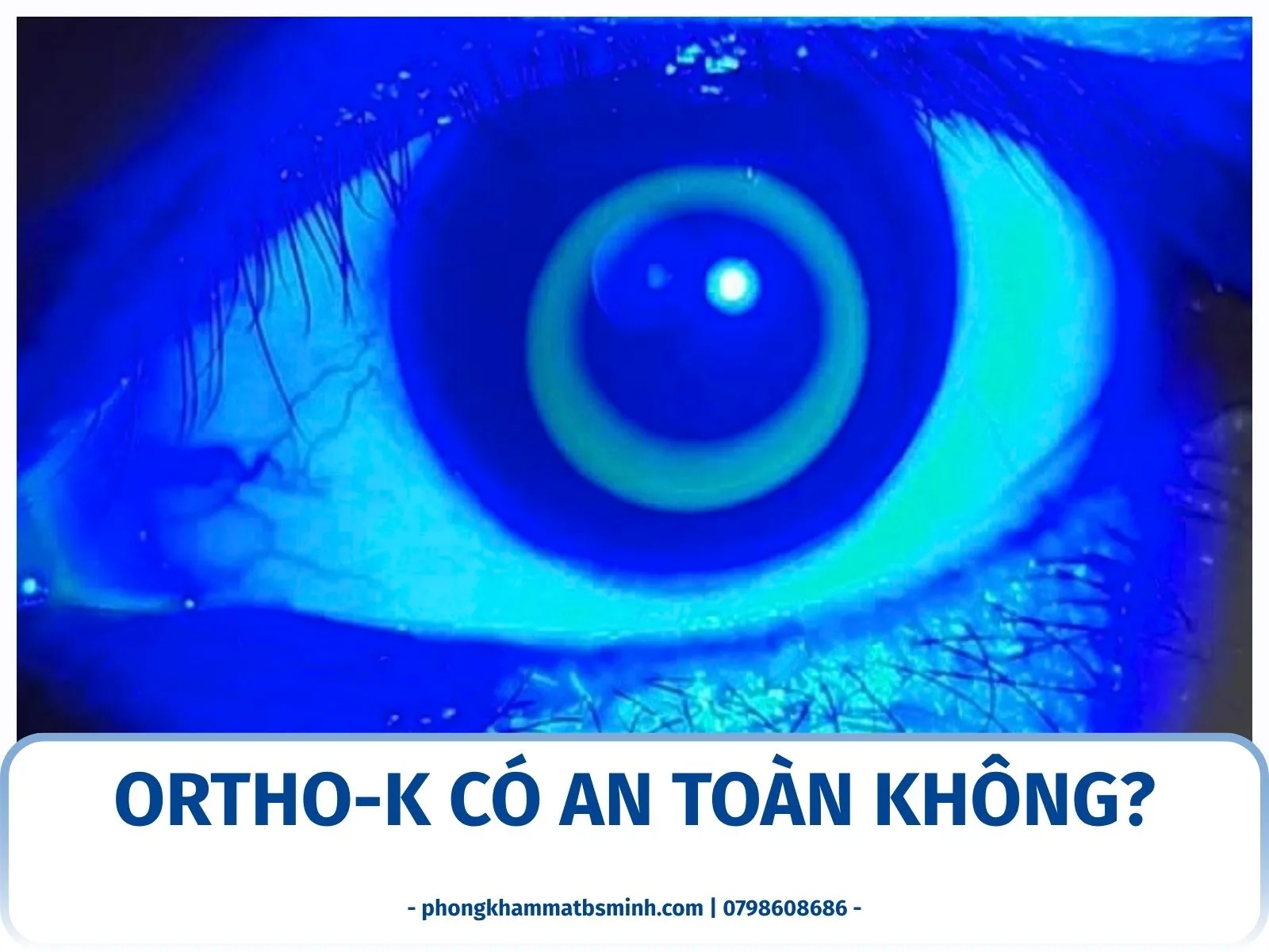 Ortho-K có an toàn không?