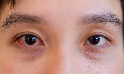 Đỏ mắt một bên có nguy hiểm không?