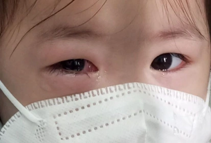 đau mắt đỏ