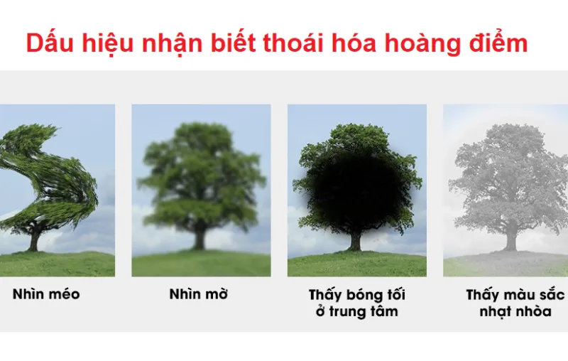 Nhìn méo hình dấu hiệu bệnh võng mạc hay hoàng điểm