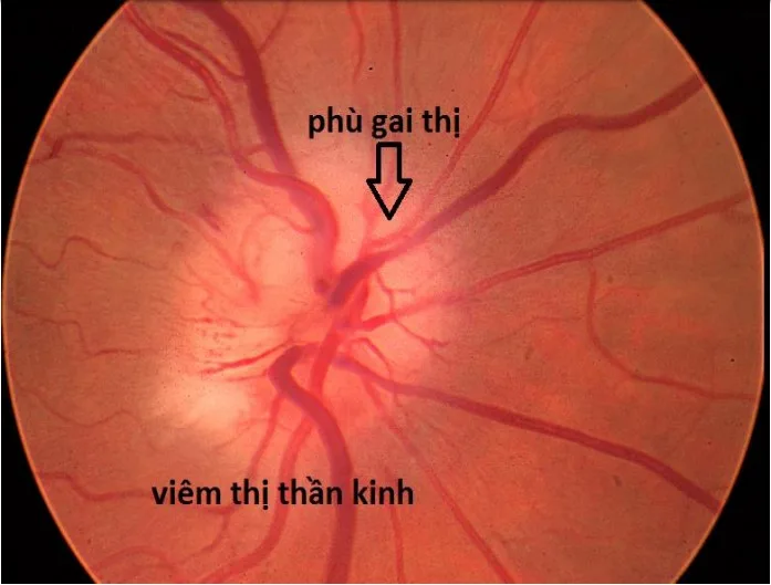 Soi đáy mắt đánh giá gai thị trong khám glaucoma Bến Tre