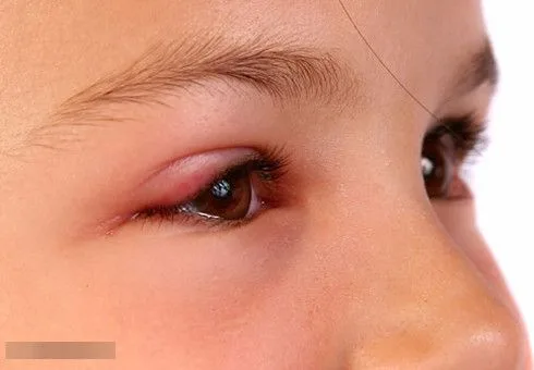Mí mắt sưng đau: chắp, lẹo hay viêm mi?