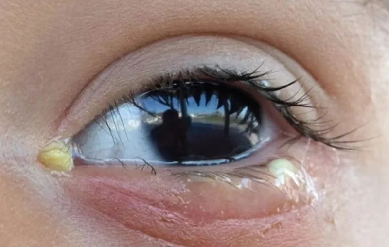 Mắt có ghèn buổi sáng viêm kết mạc hay viêm bờ mi