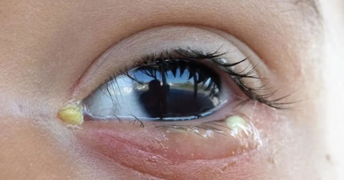 Mắt có ghèn buổi sáng viêm kết mạc hay viêm bờ mi