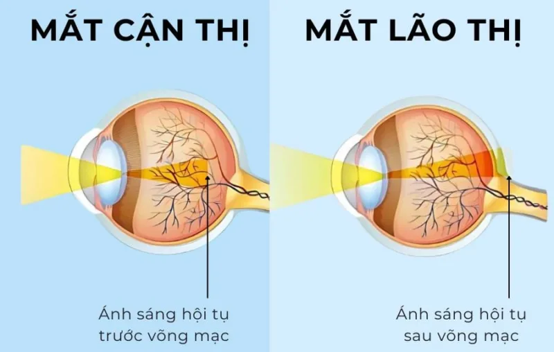 Lão thị có phải ai cũng bị không