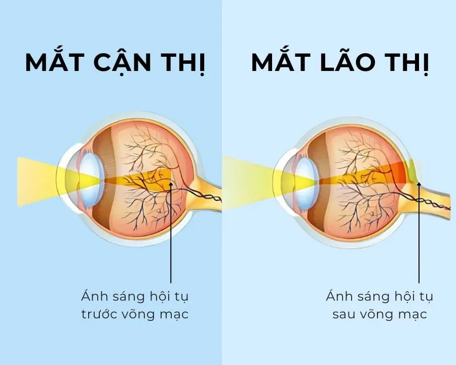 Lão thị có phải ai cũng bị không