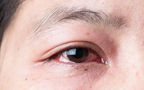 Chảy nước mắt khi ra gió: nguyên nhân thường gặp