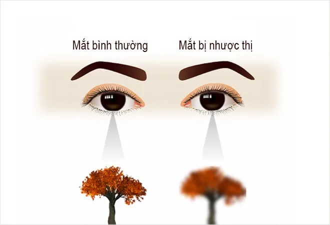 Nhược thị điều trị đến bao nhiêu tuổi còn hiệu quả