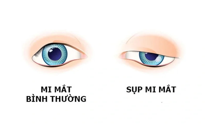 Sụp mi là gì? Khi nào cần khám mắt?