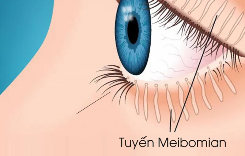 Rối loạn tuyến Meibomius