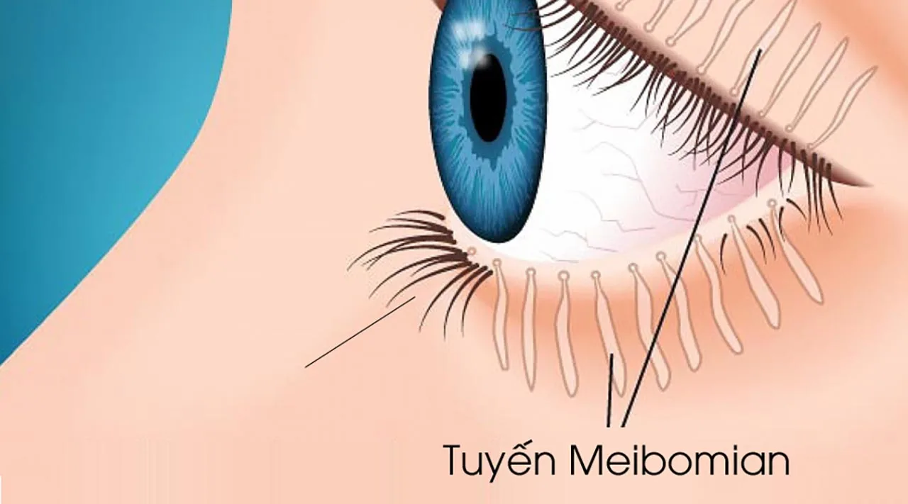 Rối loạn tuyến Meibomius