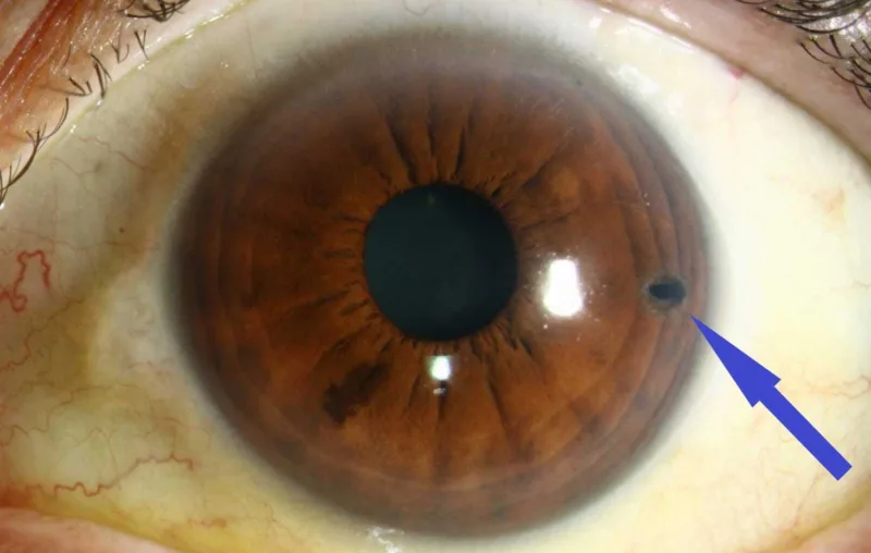 Glaucoma góc đóng cấp