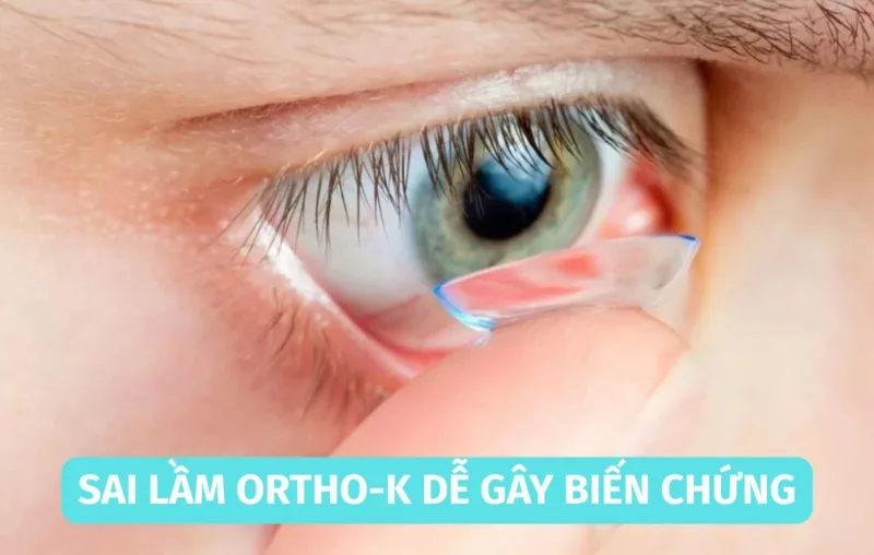 Sai lầm khi vệ sinh Ortho-K dễ gây biến chứng