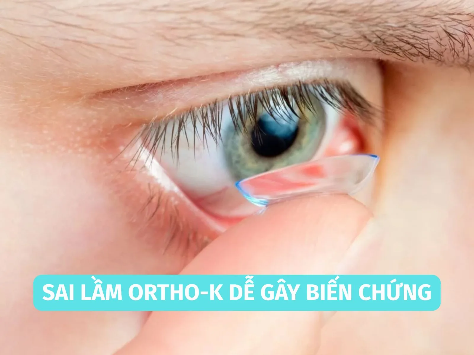 Sai lầm khi vệ sinh Ortho-K dễ gây biến chứng