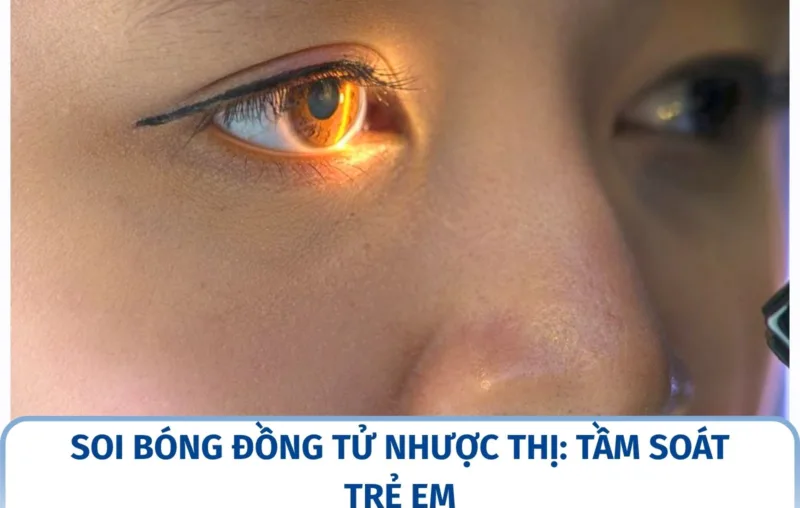 Soi bóng đồng tử nhược thị: tầm soát trẻ em