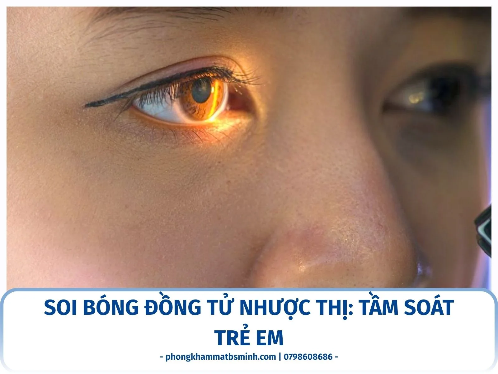 Soi bóng đồng tử nhược thị: tầm soát trẻ em